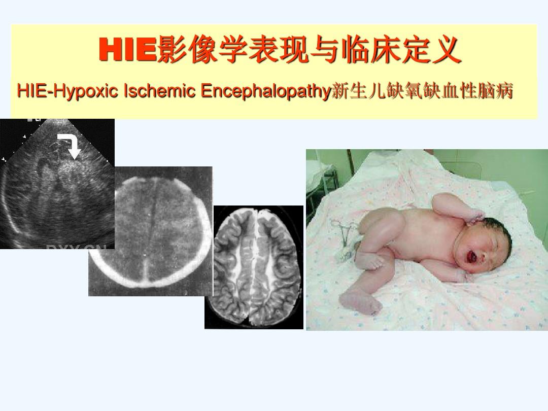 新生儿缺氧缺血性脑病影像学表现与临床定义