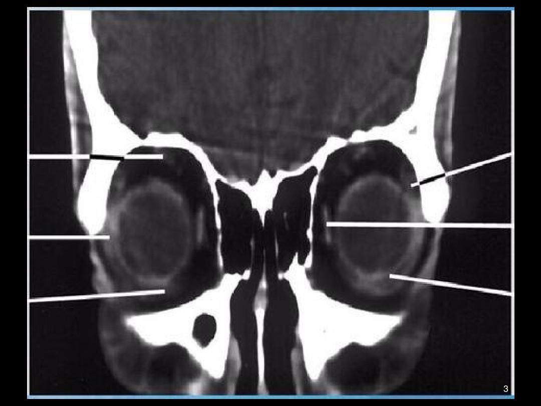 眼眶肌锥内外间隙常见病变影像学诊断PPT课件