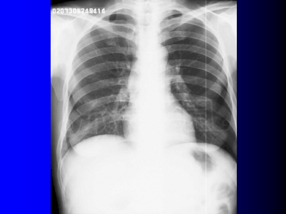 呼吸系统基本病变影像诊断
