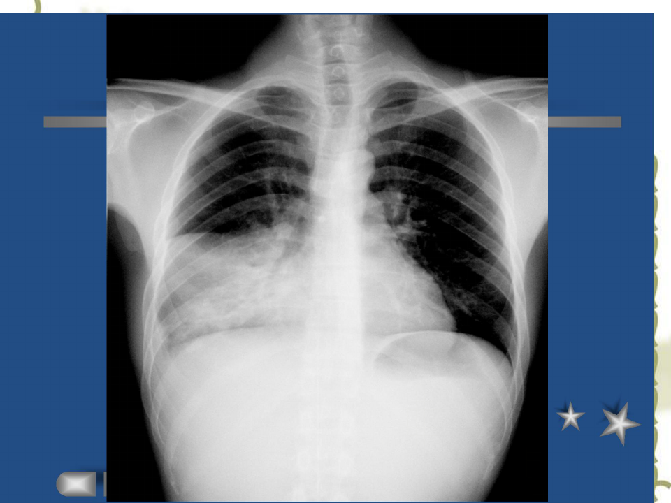 肺部感染性疾病的影像诊断