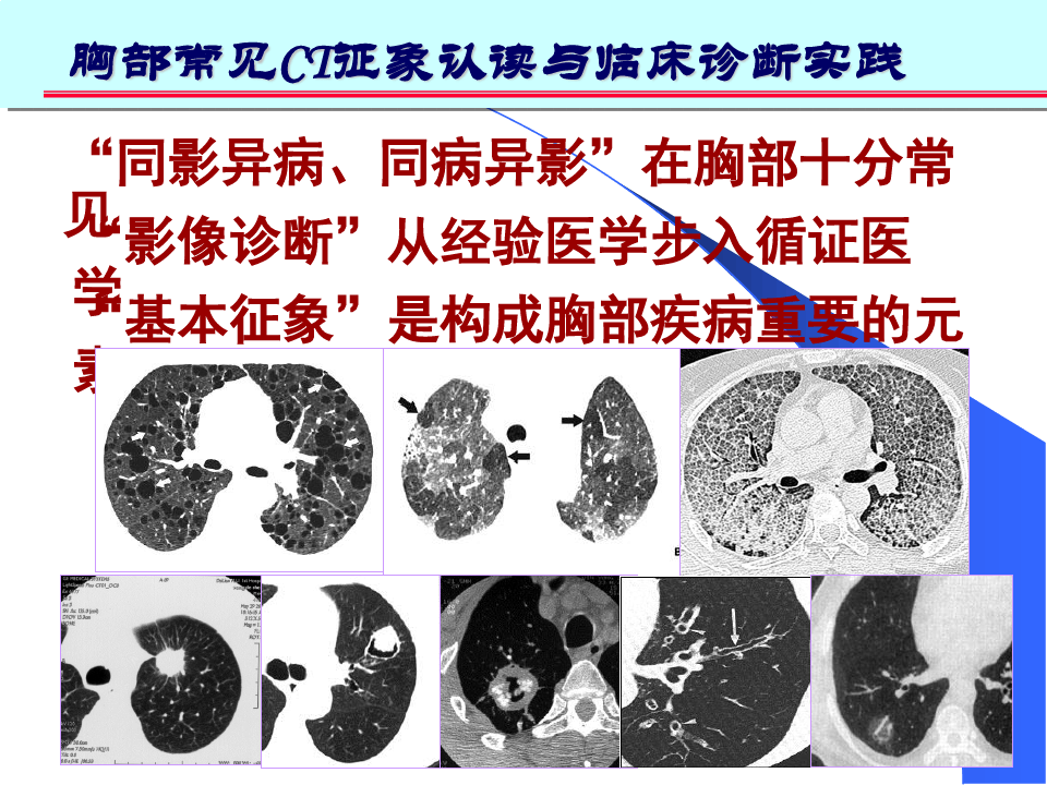 肺部CT十大征象诊断应用完整版
