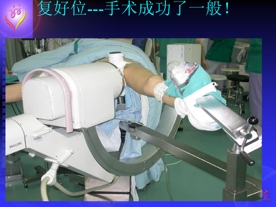 股骨转子间骨折手术方法