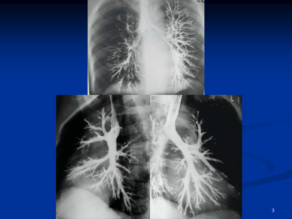 医学影像诊断学-呼吸系统3ppt课件