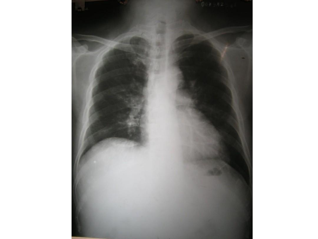病毒性肺炎胸部CT片