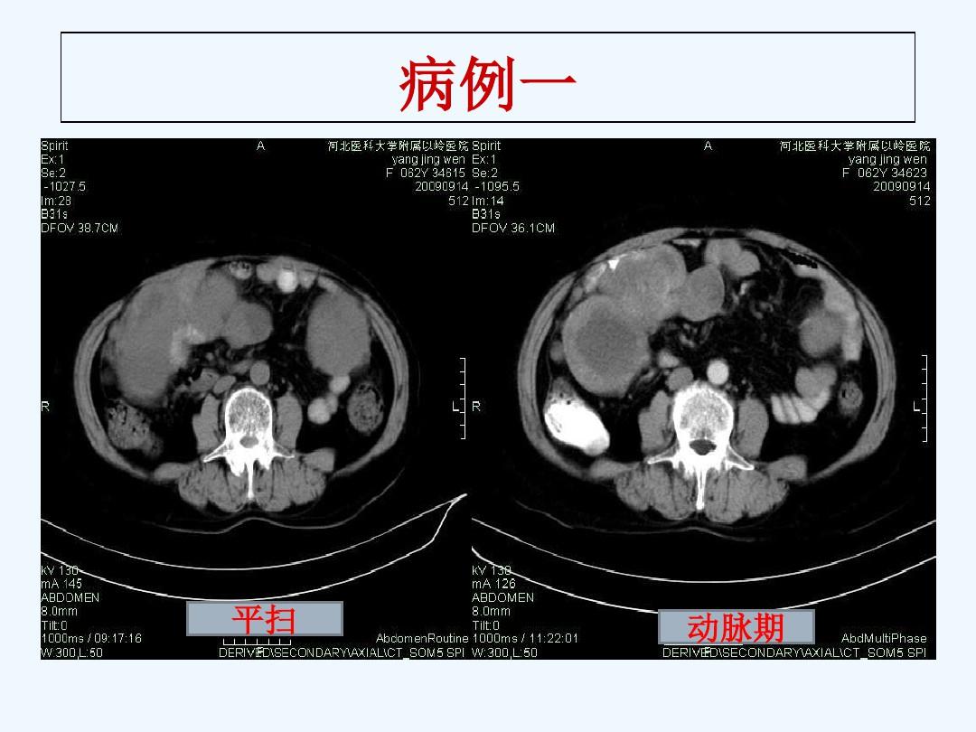 胃肠道间质瘤的影像诊断