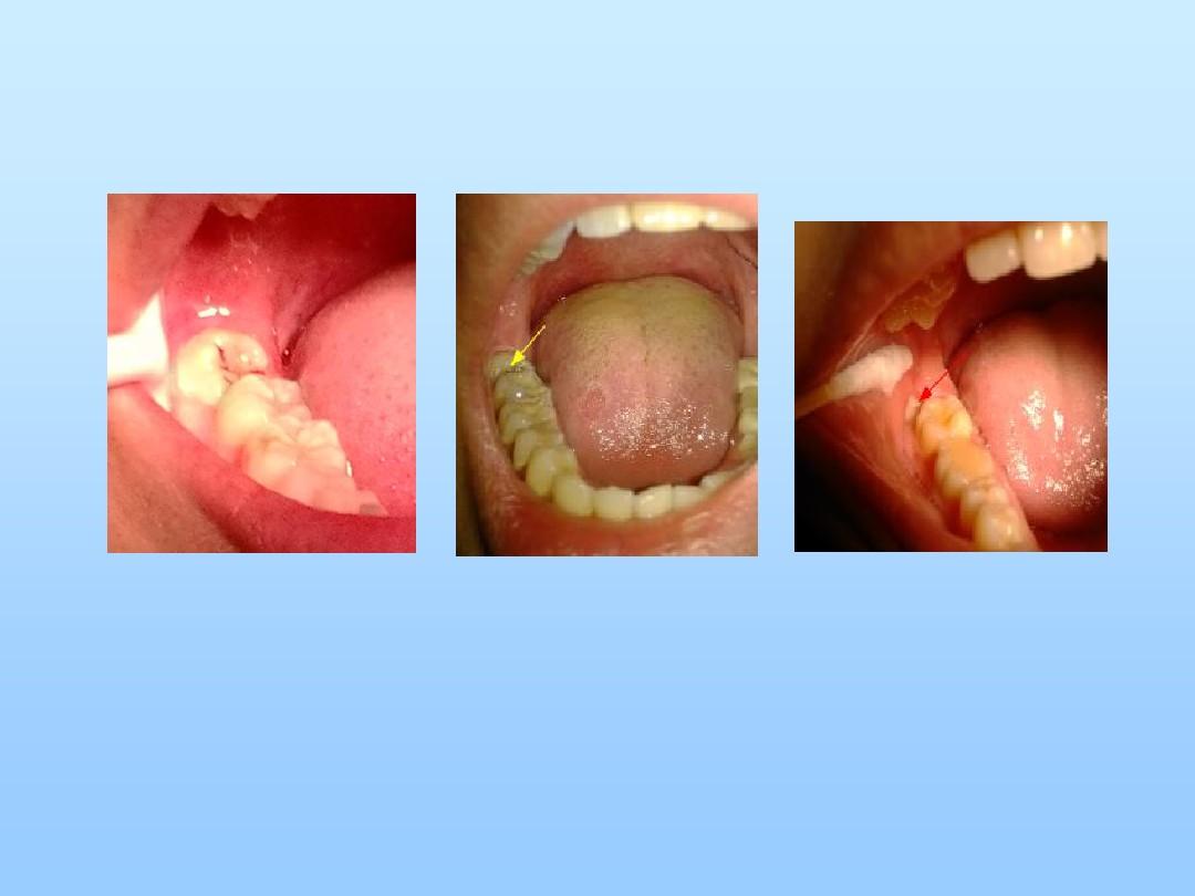下颌阻生第三磨牙拔除PPT课件