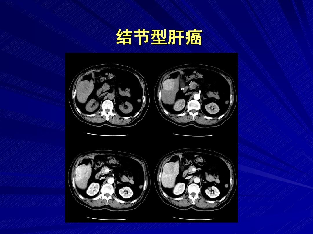 肝脏肿瘤影像诊断