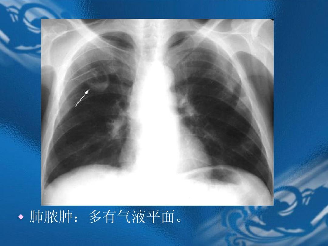 医学影像诊断学-呼吸系统2