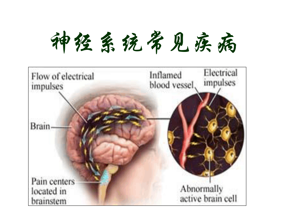 神经系统常见疾病PPT