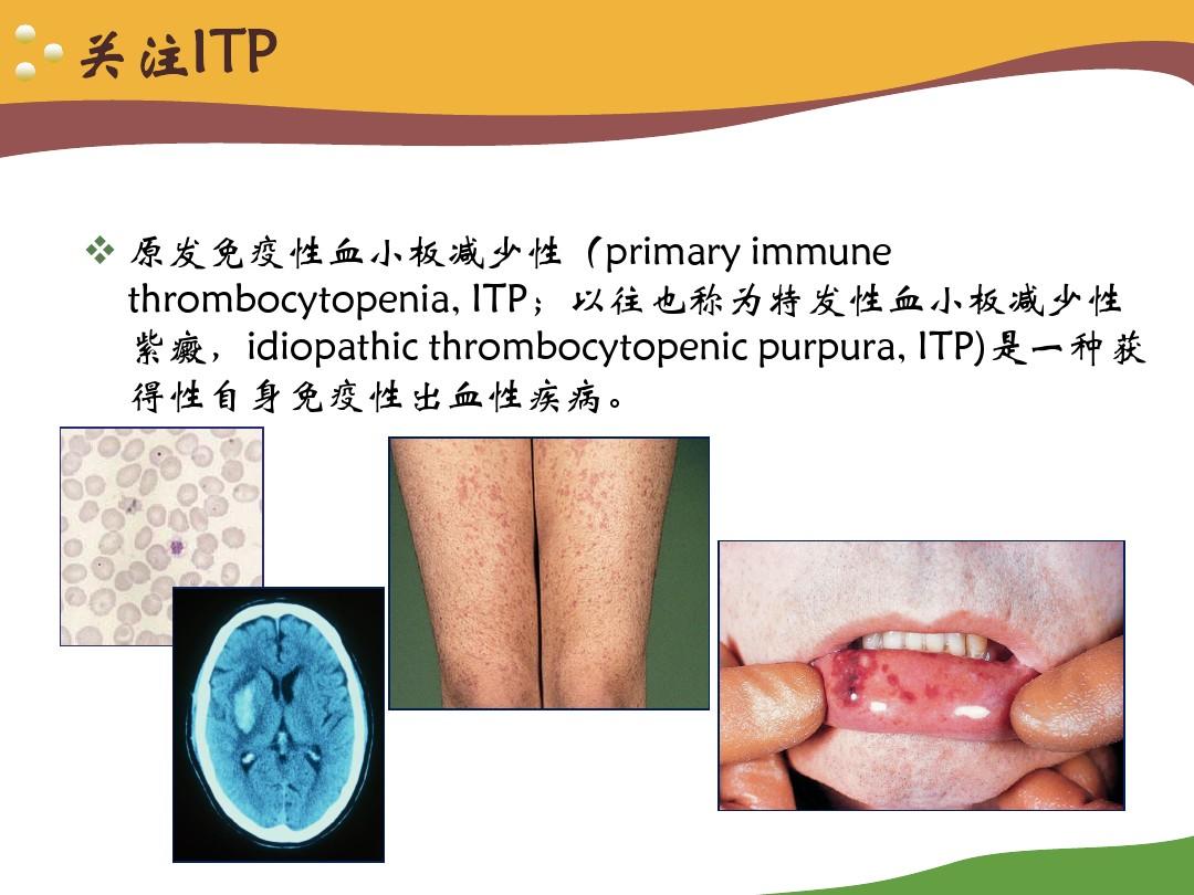 ITP诊治中国专家共识 (1)