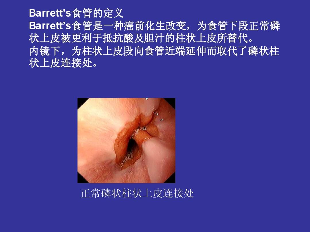 Barrett’s食管