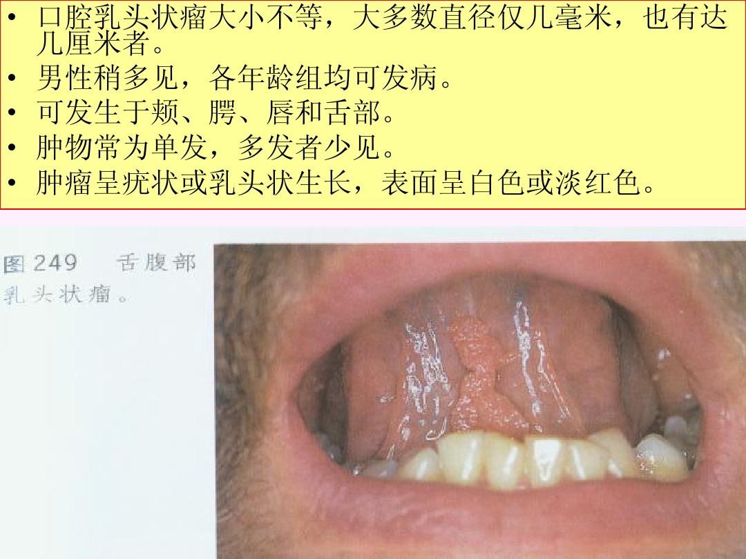 口腔颌面部其他组织来源的肿瘤