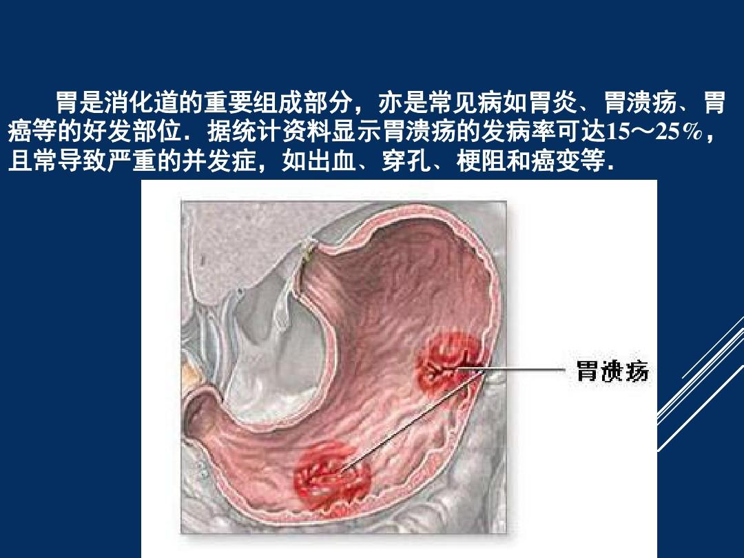 胃肠道间质瘤影像表现