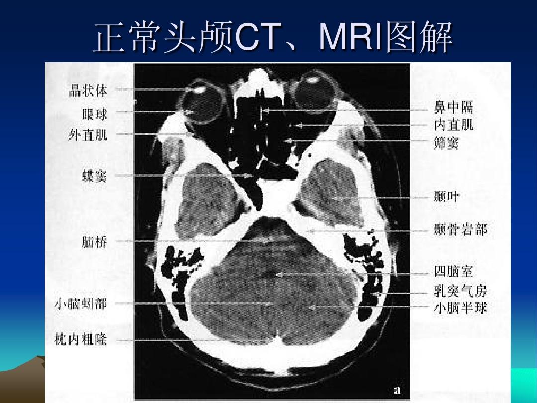 正常头颅CT,MRI图解