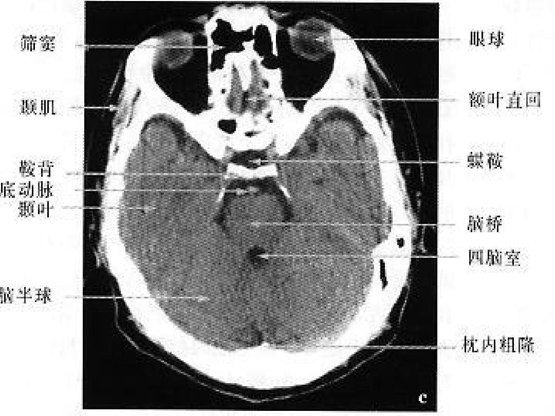 正常头颅CT,MRI图解