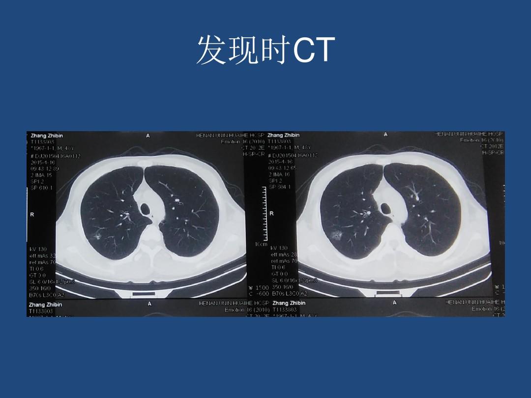 一例肺GGN的诊疗历程