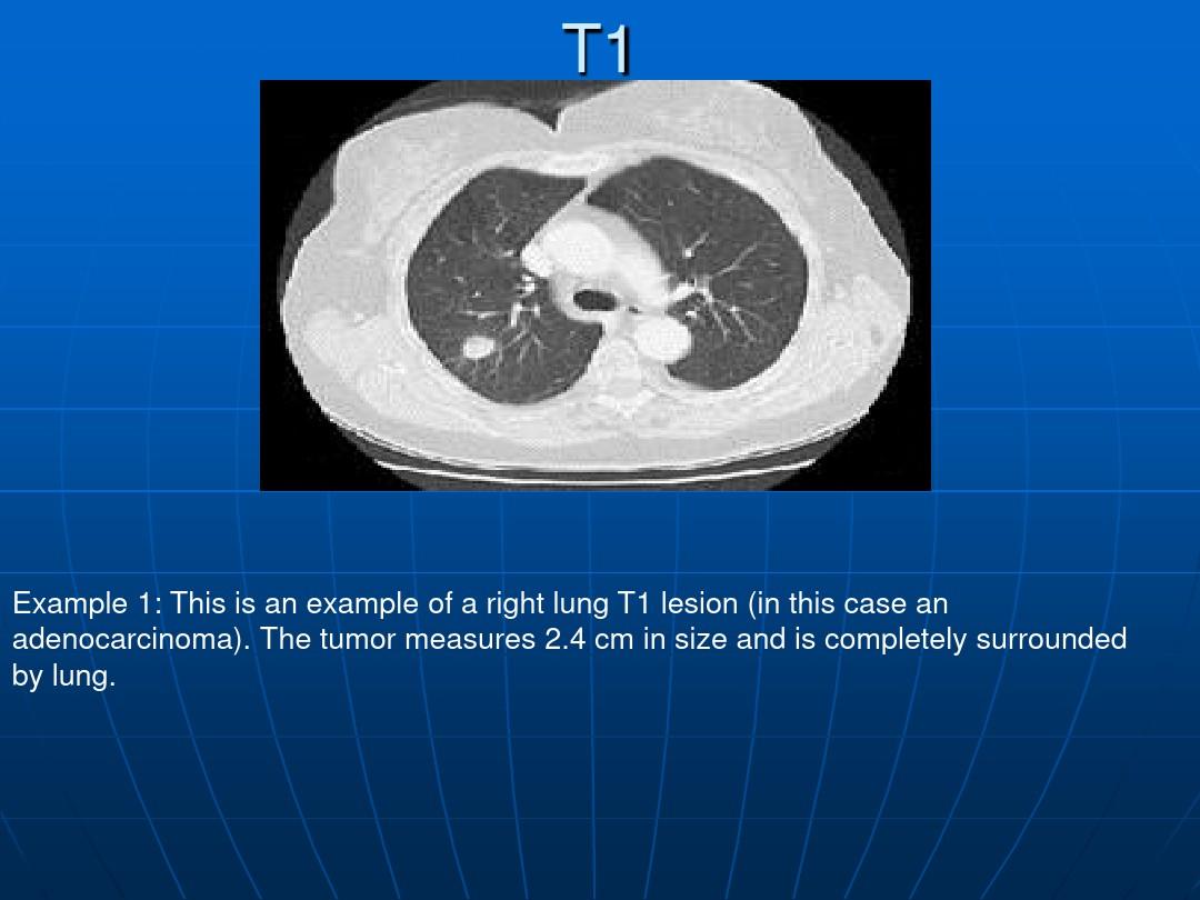 肺癌肿瘤分期与CT影像学表现